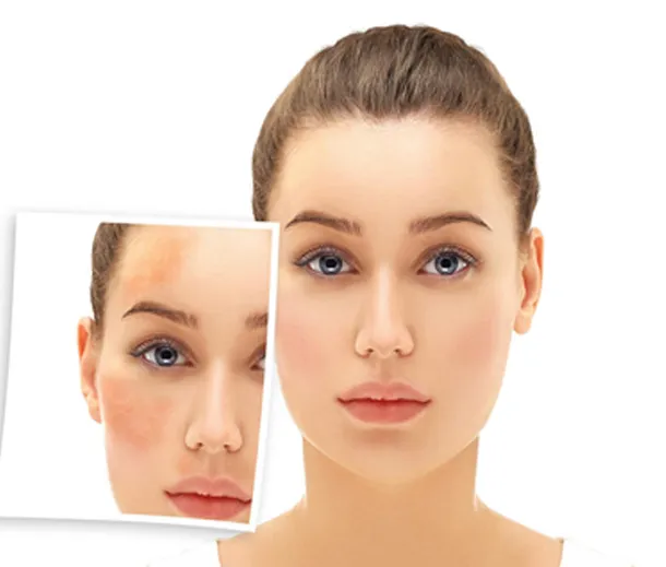 Dermaquest peel — Skin Brite x6