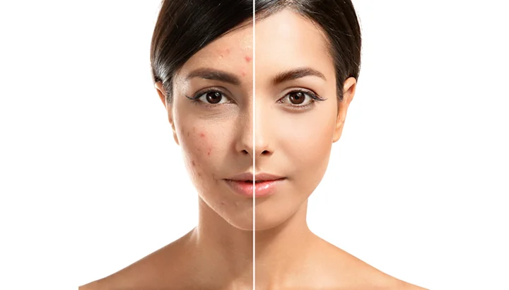 Split before-and-after of the same face showing active inflammatory acne and post-inflammatory marks on the left and clear, even skin on the right, the kind of outcome an Acnelan course at CoLaz is structured to deliver