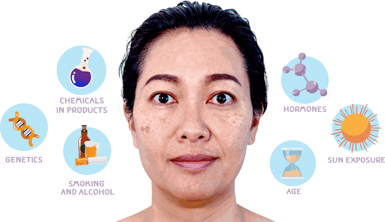 Fine electrolysis probe used at CoLaz for precision in-clinic age spot treatment