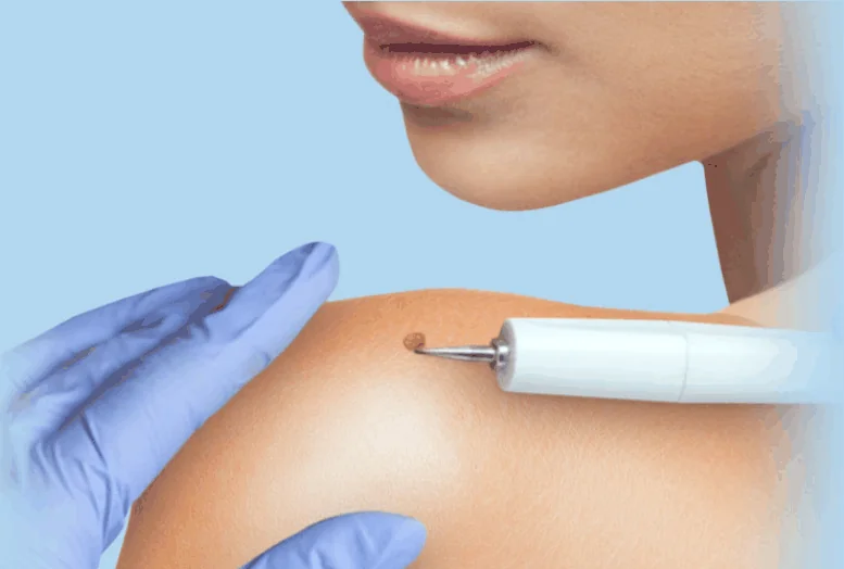 CoLaz clinician using a fine electrolysis probe to treat a small common wart on a patient's shoulder during an in-clinic removal session