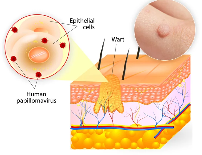 Medical illustration showing how the human papillomavirus infects epithelial cells to form a common wart, with a close-up photo of a wart on the skin