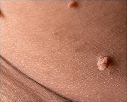 Close-up of common warts on the skin showing the rough raised texture typical of HPV lesions treated at CoLaz