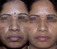 Before and after comparison of a CoLaz Cosmelan patient with melasma showing significant clearing of dark cheek and forehead pigmentation following the six-month depigmentation regimen