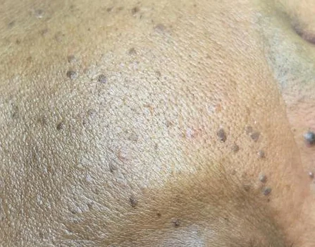 Close-up of a cluster of DPN papules across the temple and cheek of a darker skin tone, the typical presentation assessed at CoLaz before a staged removal plan