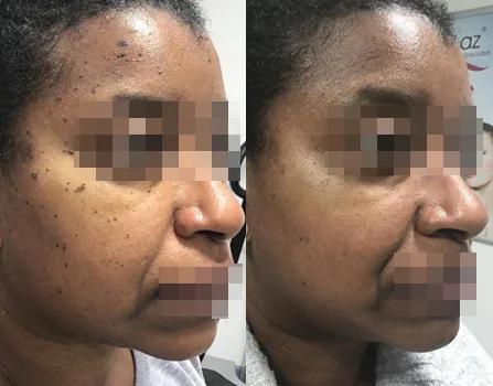 Before and after comparison of a CoLaz DPN patient showing clear reduction of the dark papules across the cheek and temple following a staged course of treatment