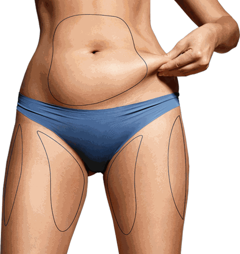 Body diagram with contour lines marking the most popular electrolipolysis treatment areas across the abdomen, flanks and outer thighs