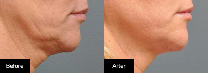 Defined jawline and lifted skin after a HIFU treatment at CoLaz