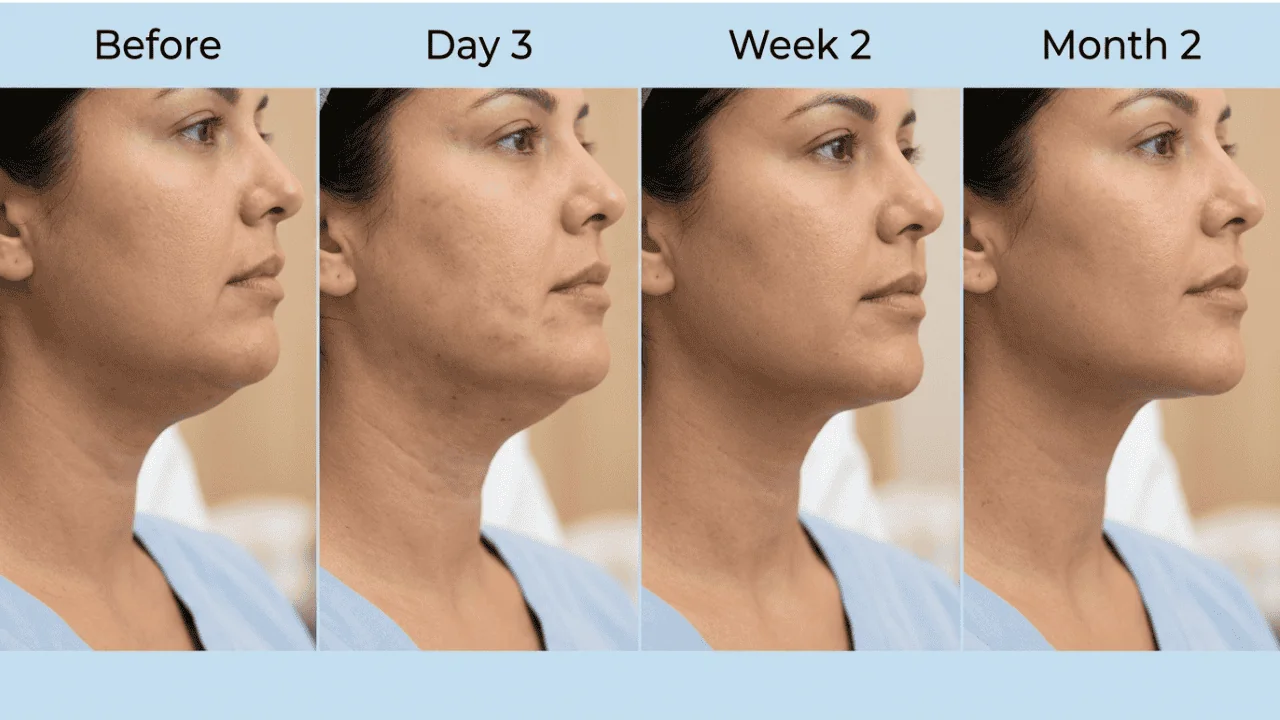 Four-stage timeline of a Lemon Bottle chin treatment showing before, day three swelling, week two settling and the refined jawline at month two