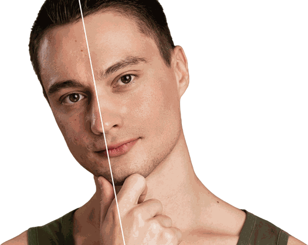 Side-by-side comparison of a CoLaz patient's skin before and after a course of Dermapen microneedling