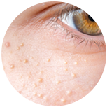 Close-up of the eye area showing a cluster of tiny white keratin-filled milia under the lower lash line, the most common pattern treated at CoLaz