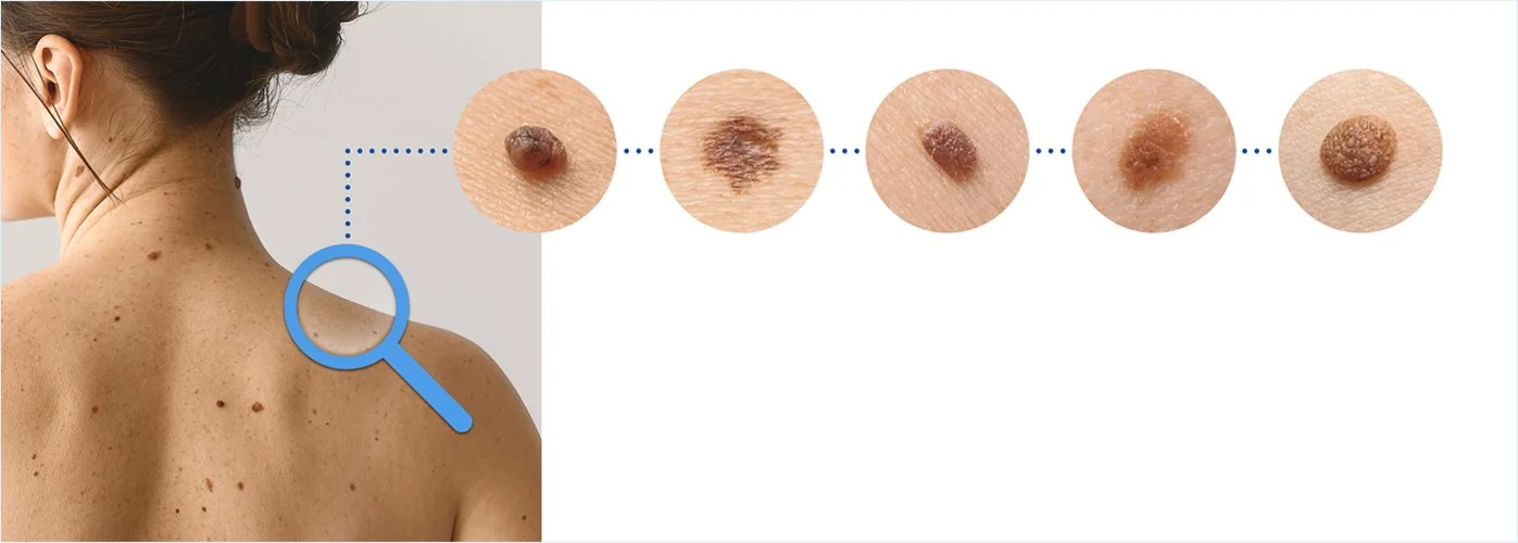 Advanced electrolysis probe used at CoLaz for cosmetic in-clinic mole removal