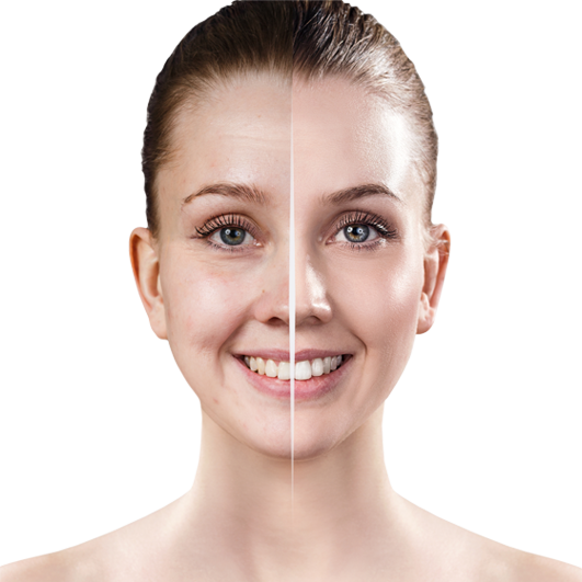 Before and after split showing brighter, more even skin after a course of oxygen facials at CoLaz