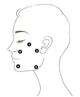 Five-point Bio-Aesthetic Points map for Profhilo on a side-profile face diagram