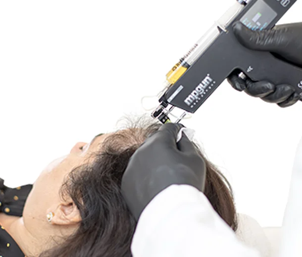 Close-up of the M8 Gun delivering an even pattern of platelet-rich plasma microinjections across a female patient's scalp for diffuse crown thinning
