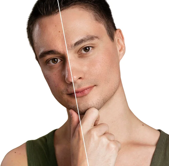 Before and after split of a male patient showing clearer, firmer skin after a course of salmon DNA polynucleotide at CoLaz
