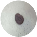 Fine electrolysis probe used at CoLaz for precision in-clinic benign lesion treatment