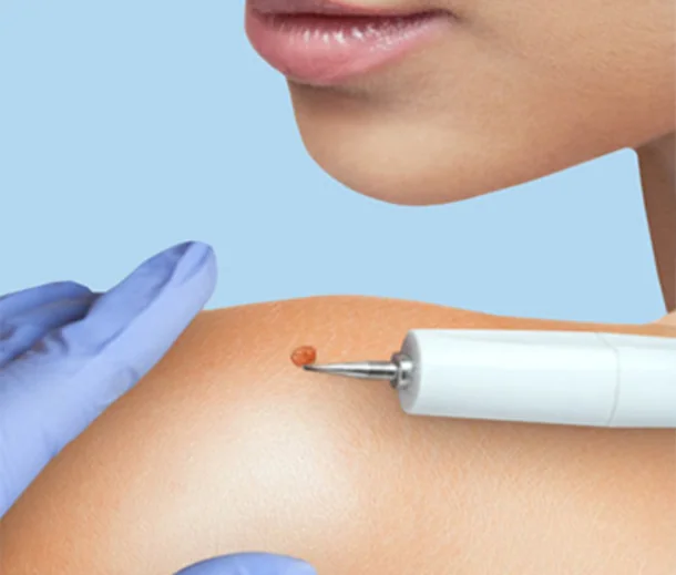Calm settled skin with antiseptic balm applied after an in-clinic procedure