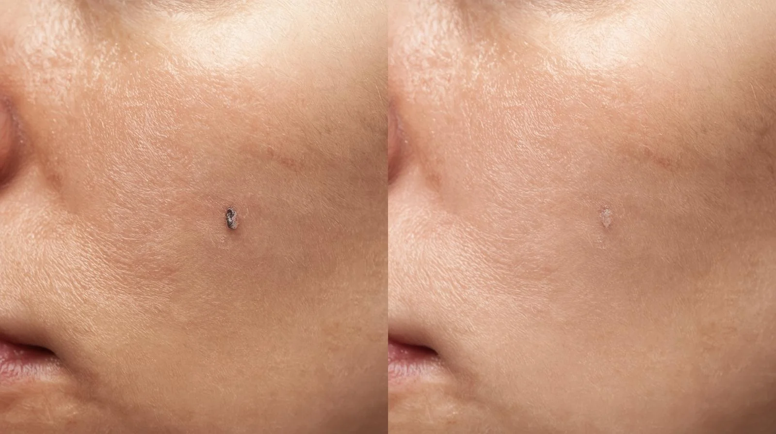 Calm skin after a precision in-clinic blemish treatment with barrier balm