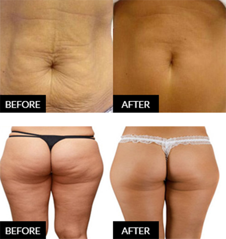 Before and after ultrasound cavitation comparison showing improved skin tone on the abdomen and smoother contour across the thighs and buttocks