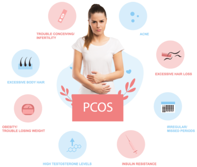 PCOS and Laser Hair Removal: Everything You Need to Know