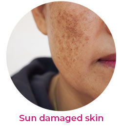 sun damage skin