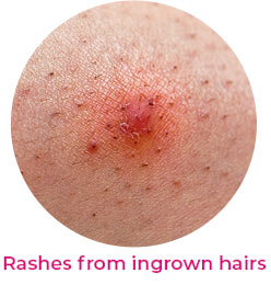 Rashes from ingrown hairs