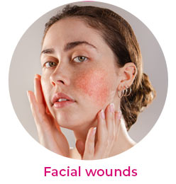 Facial wounds