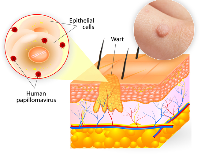 Common Wart Removal | Advanced Electrolysis