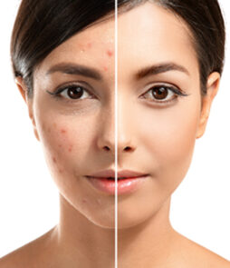 Cosmelan Peel – Summer Offers