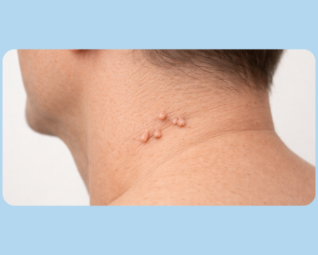 Skin tags on neck showing small