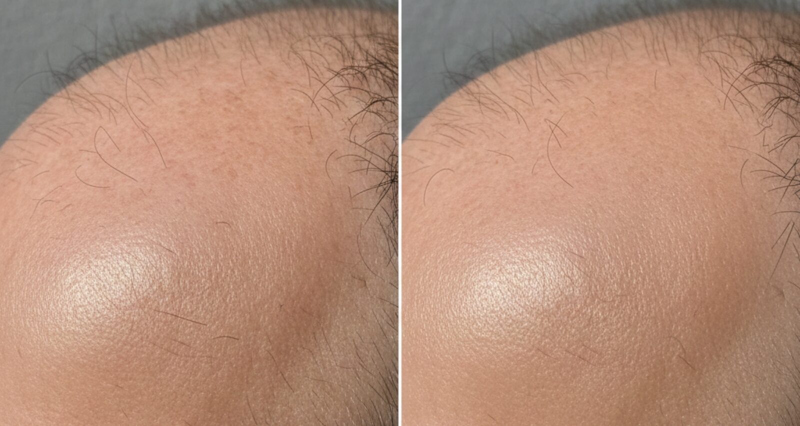 Before and after scalp laser hair reduction for men