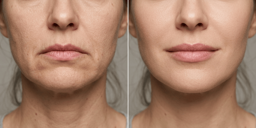 Botox for downturned mouth before and after results