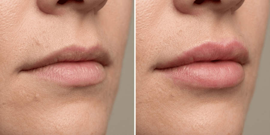Botox lip flip before and after results UK